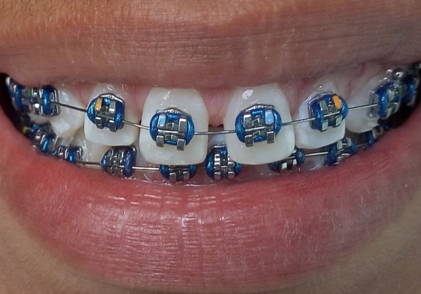 Brackets